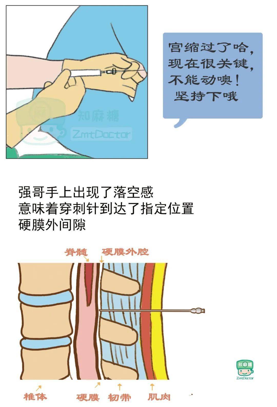 123kg产妇的椎管内麻醉小宝完