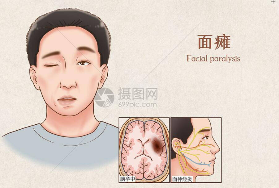 病是由于人体正气不足,脉络空虚,卫外不固,又加上风寒之邪侵袭头面部