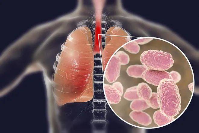 已致13人死亡！这个古老的疾病又开始肆虐了！_发病_传播_年龄