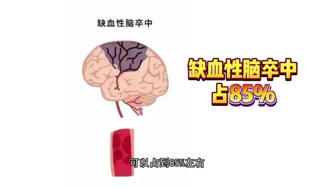 健康科普讲堂∣脑卒中离我们并不远