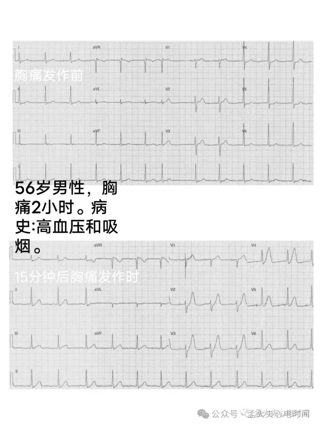 t波高尖心电图表现图片