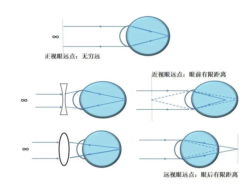 近视眼光路图图片