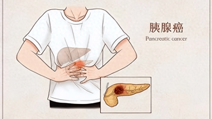 49岁男子坚持运动不久坐,仍被确诊胰腺癌!医生指出:4件事害了他