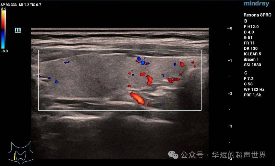 甲状腺上下动脉超声图图片