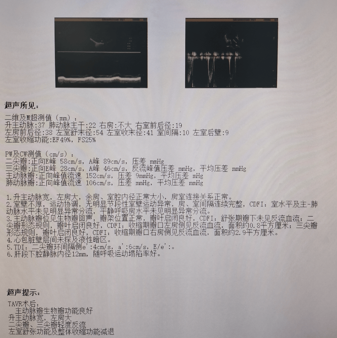 位置好,形态佳,血流动力学得到即刻改善,术后一周超声提示左心较术