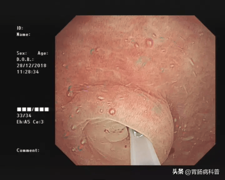 肠道下端狭窄肠镜通过困难等不宜进行内镜治疗