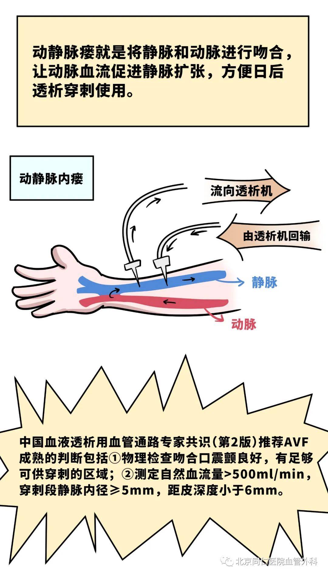 动静脉内瘘 卡通图片