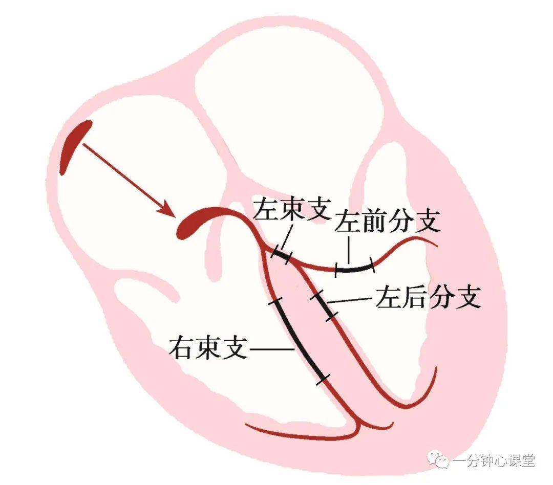 左后分支传导阻滞图片