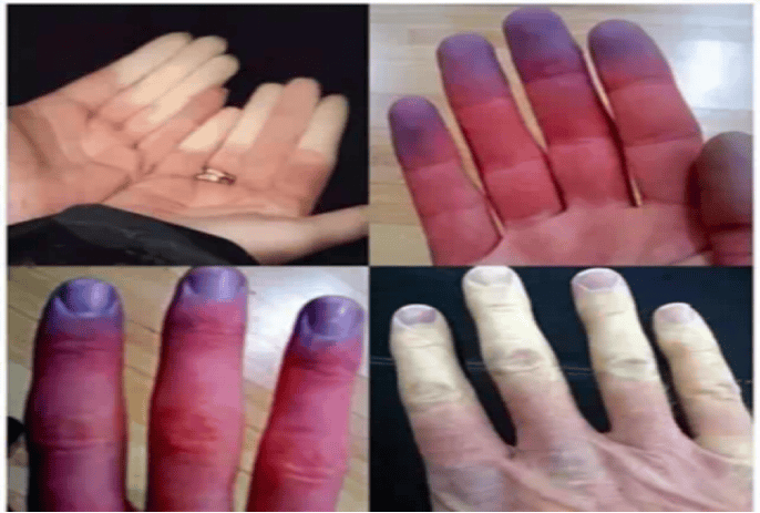 手指贫血图片图片