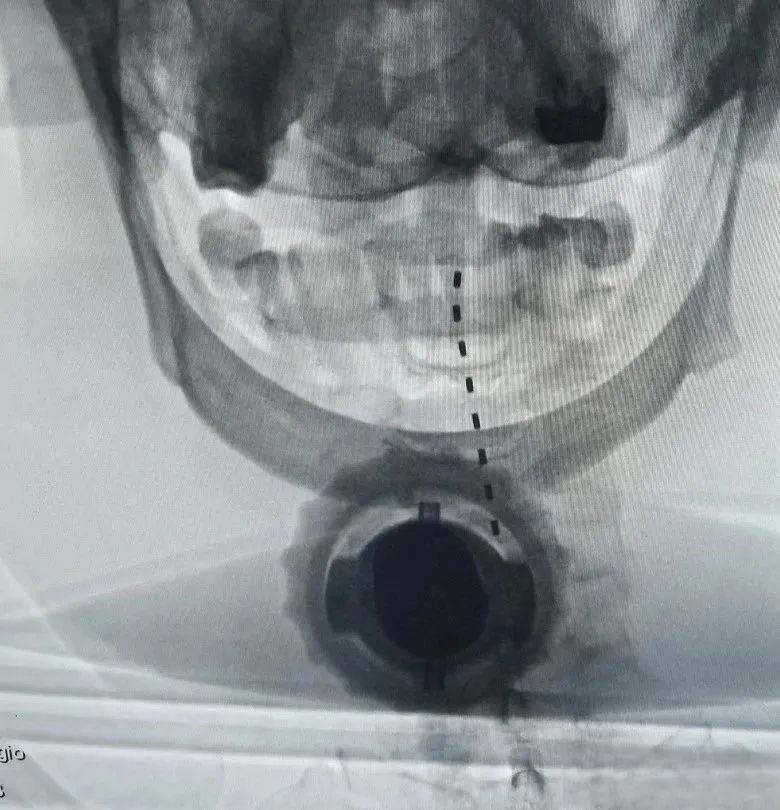 品驰特约 | 专访辽宁省人民医院黄海韬:积累数十例植物人脊髓电刺激