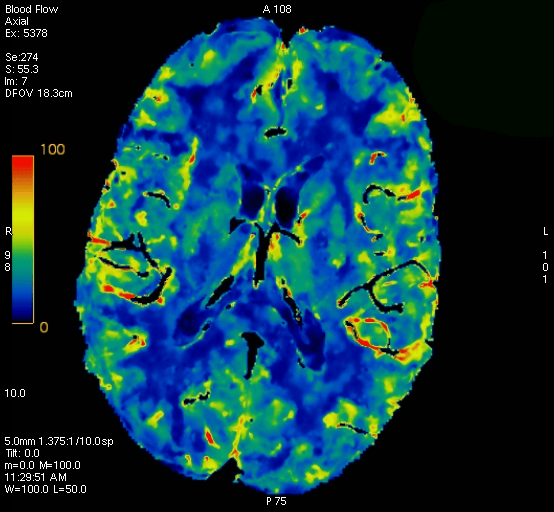 脑灌注成像颜色解读图片