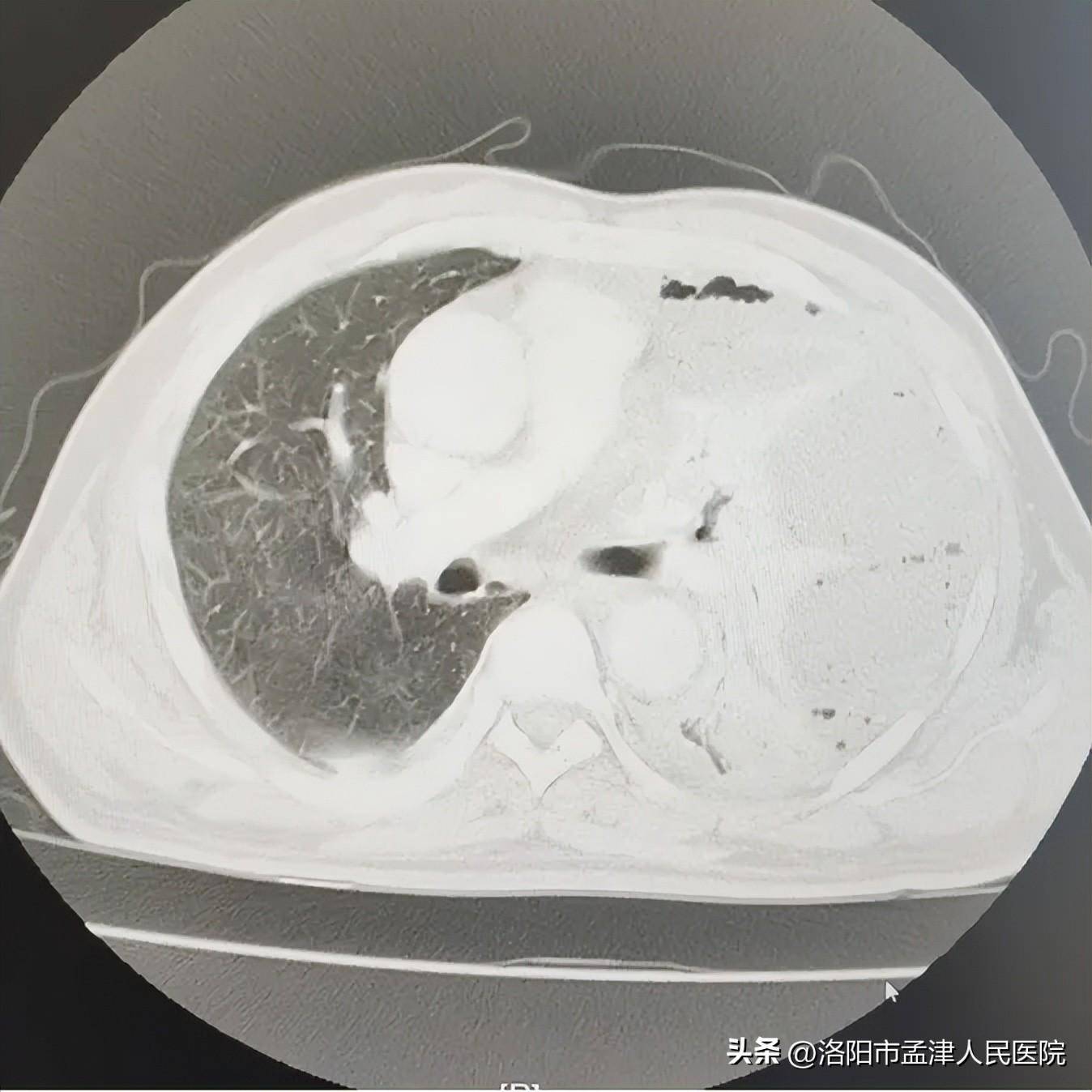 孟津人民医院胸外科为脓胸患者解除病痛