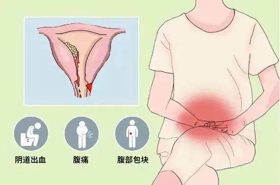 绝经后阴道出血为绝经后子宫内膜癌患者的主要症状