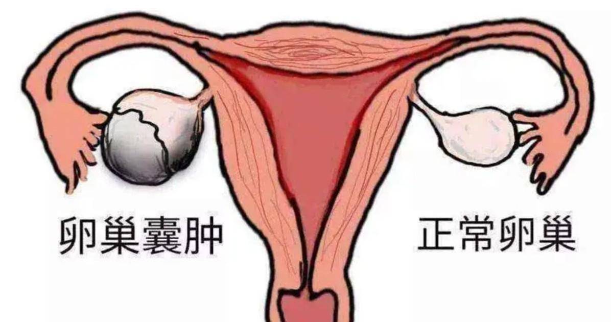 女性右侧阴囊肿图片图片