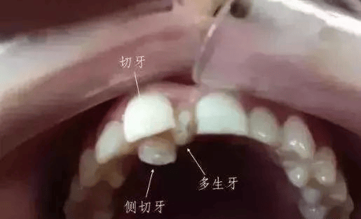 颅内多牙症图片图片