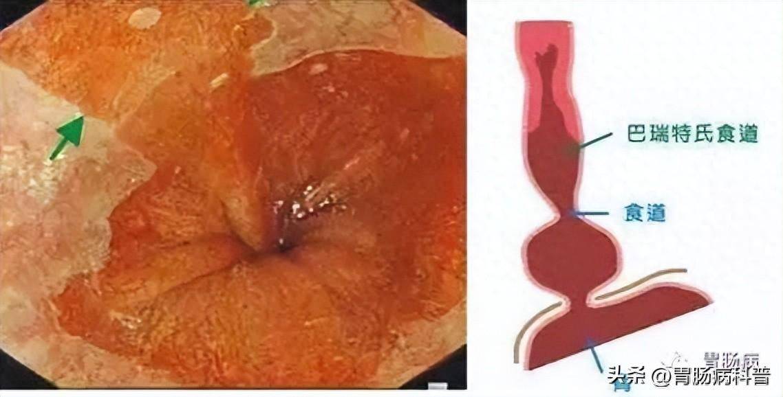 食管癌重要的癌前疾病——巴雷特食管(barretts)