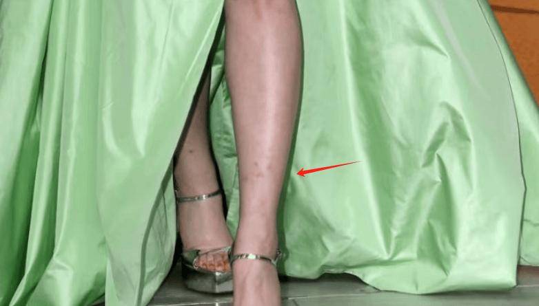 女明星那样在全身抹上素颜霜营造出"妈生好皮"的假象,连腿上的蚊子包