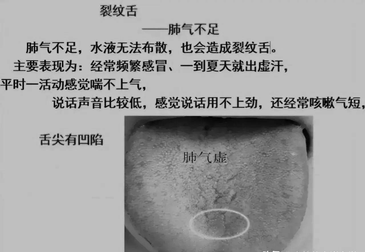 出现裂纹舌最常见的10大原因,一一为你解答!