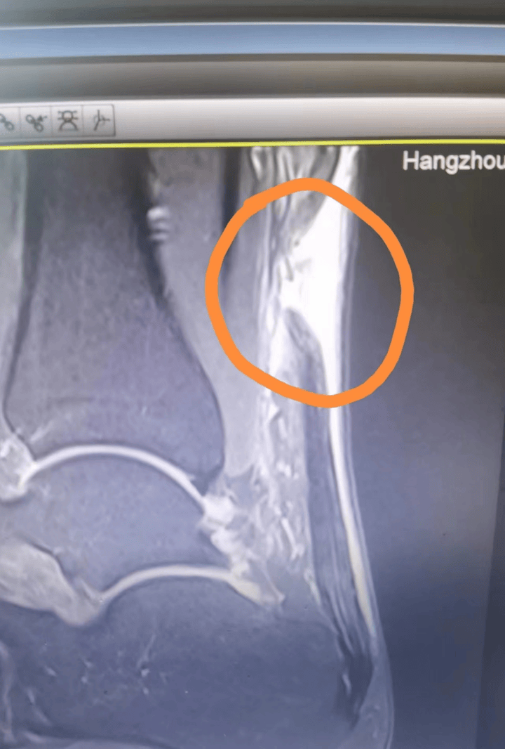 敏锐地感觉到他并不是简单的小腿肌肉拉伤,很可能是遭遇了跟腱撕裂的