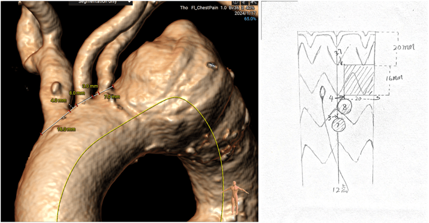 61 人工血管材质(医用涤纶),保障窗口灼烧成型后无毛边,编织结构