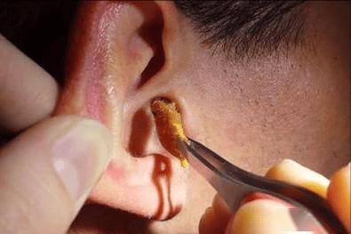 耳朵瘙痒难耐,却掏不出任何东西?或是提醒你这些疾病