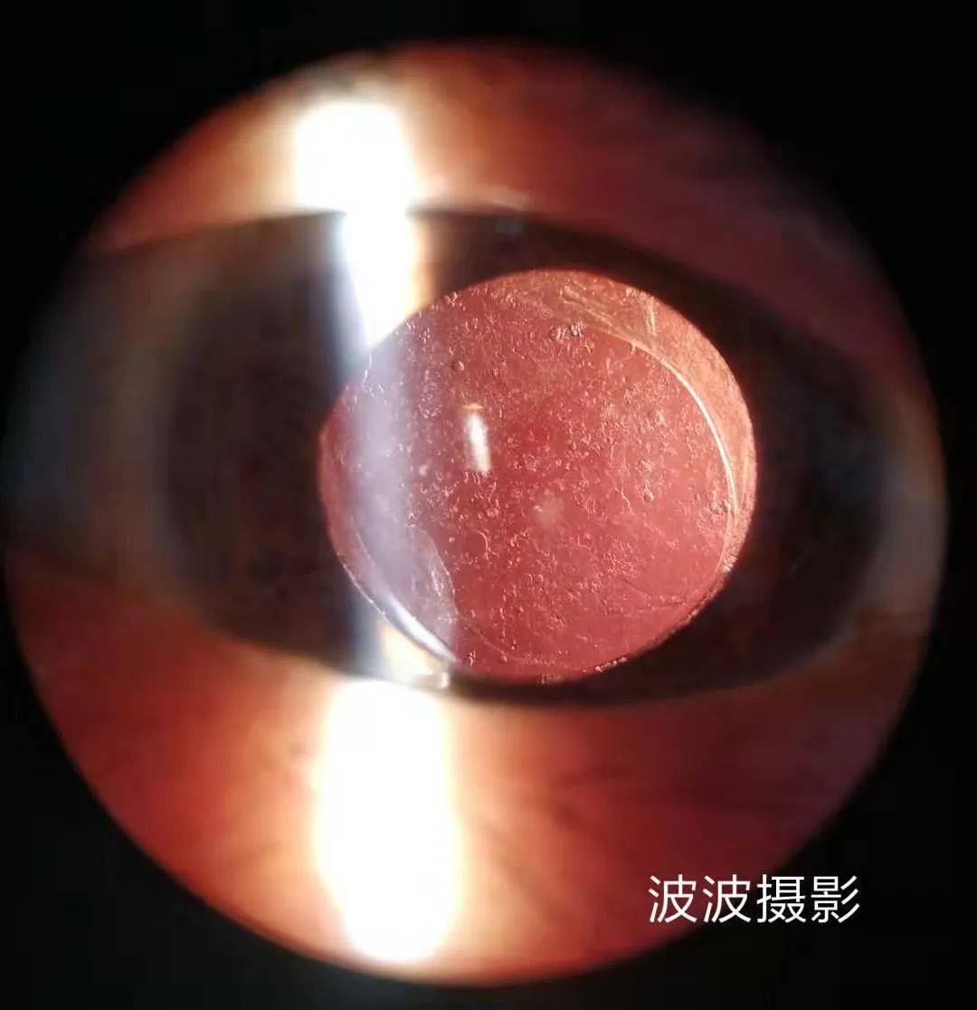 眼科图谱100张 | 裂隙灯下眼科图片分享_角膜_秘籍_医生
