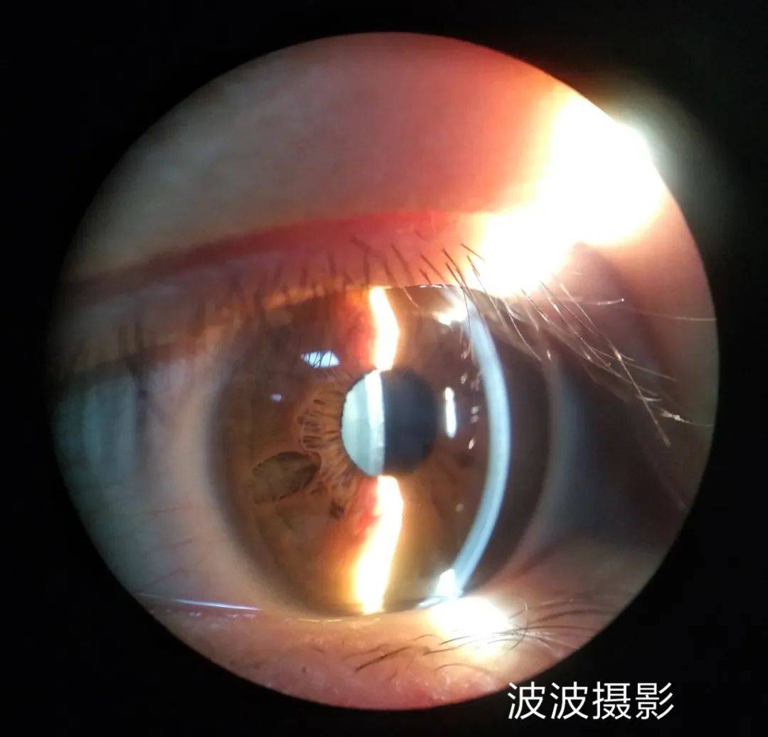 眼科图谱100张 | 裂隙灯下眼科图片分享_角膜_秘籍_医生
