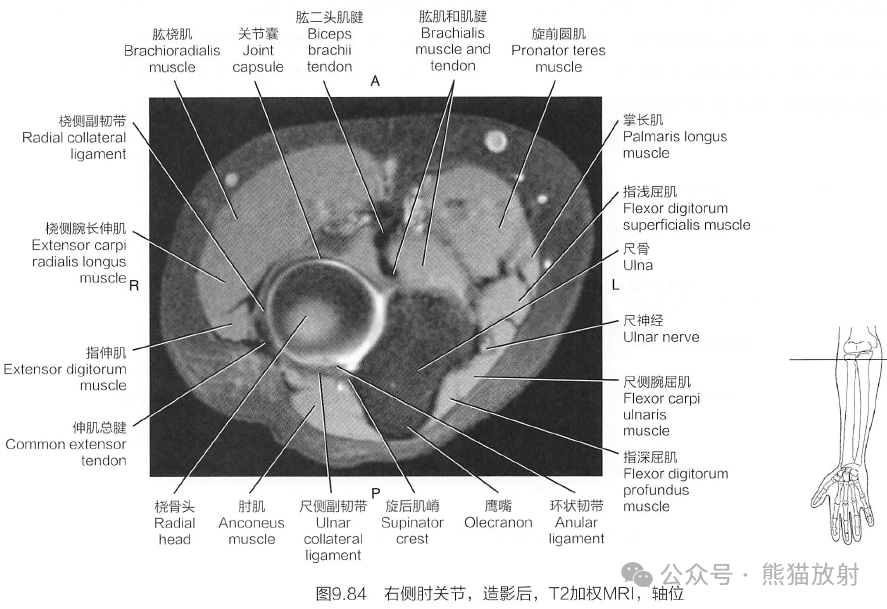 肘关节正常ct解剖图图片