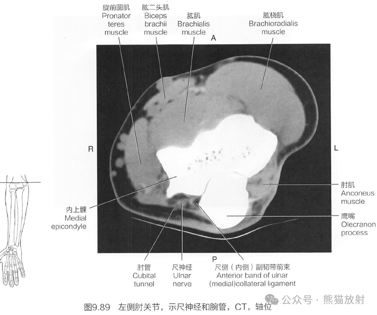 肘关节横断解剖图CT图片