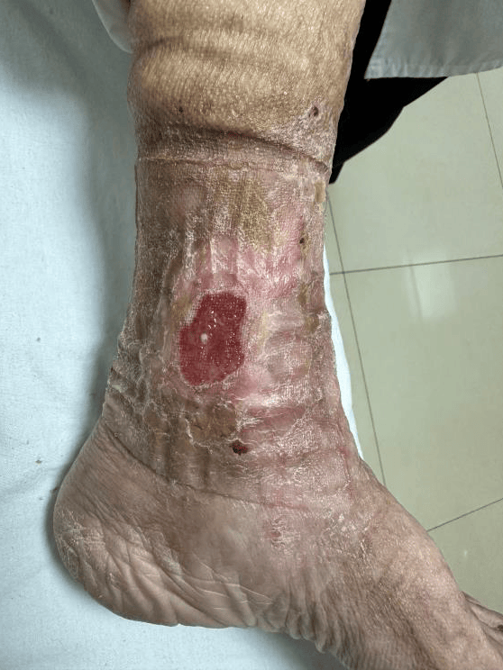 复杂创面(老烂脚)专病门诊开诊啦!