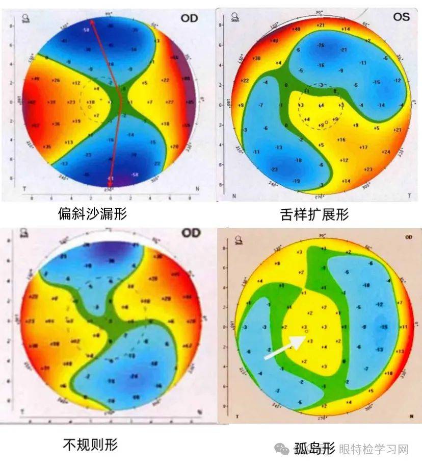 角膜地形图怎么看图片