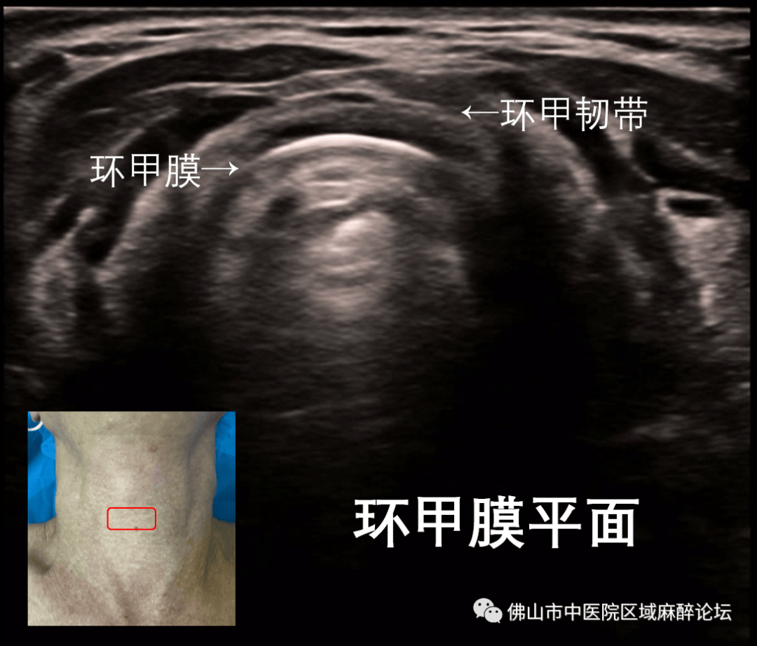 男性环状软骨突出图片图片