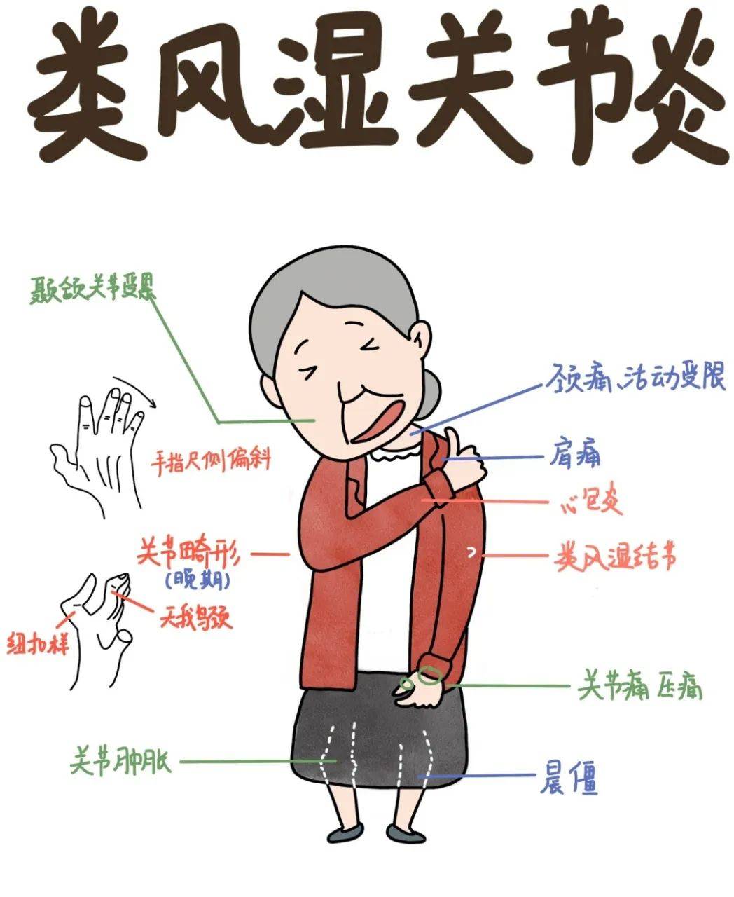 类风湿性关节炎,早期药物治疗很关键!