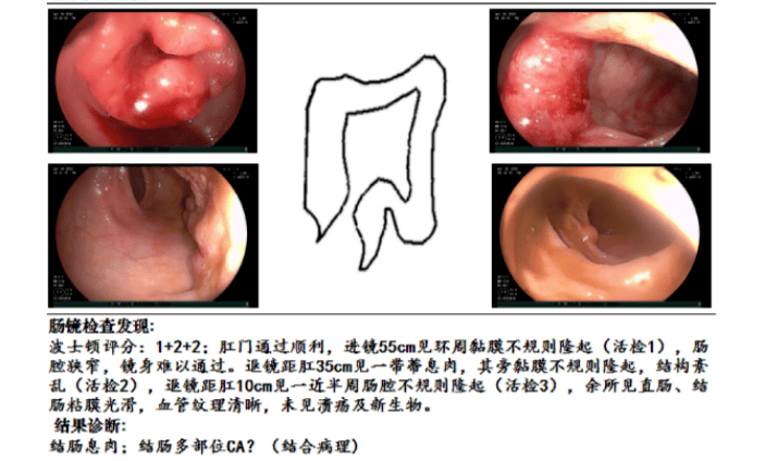 降结肠和升结肠的2个肿瘤造成肠腔狭窄,进而导致肠梗阻,这种情况及其