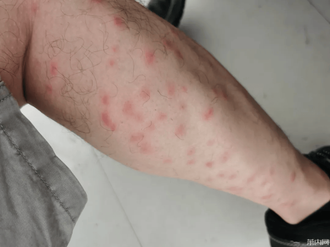 小伙说,这蠓比蚊子毒多了,关键是它咬人没感觉,毫无防备,回到家才发现