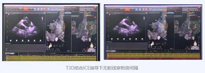 哈尔滨医科大学附属第四医院心内科乐成开展Marshall静脉+射频消融治疗顽固性房颤（哈尔滨肿瘤医院内科）哈医大四院放射科主任，