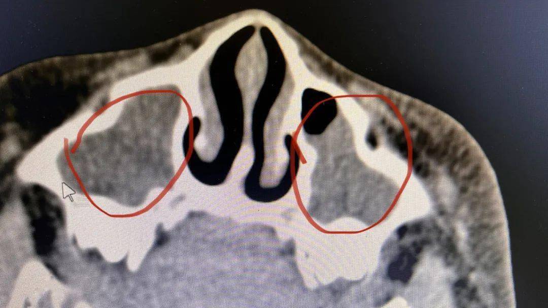 孩子症状半年时间,也不典型,所以建议查一查鼻窦ct:发现腺样体肥大