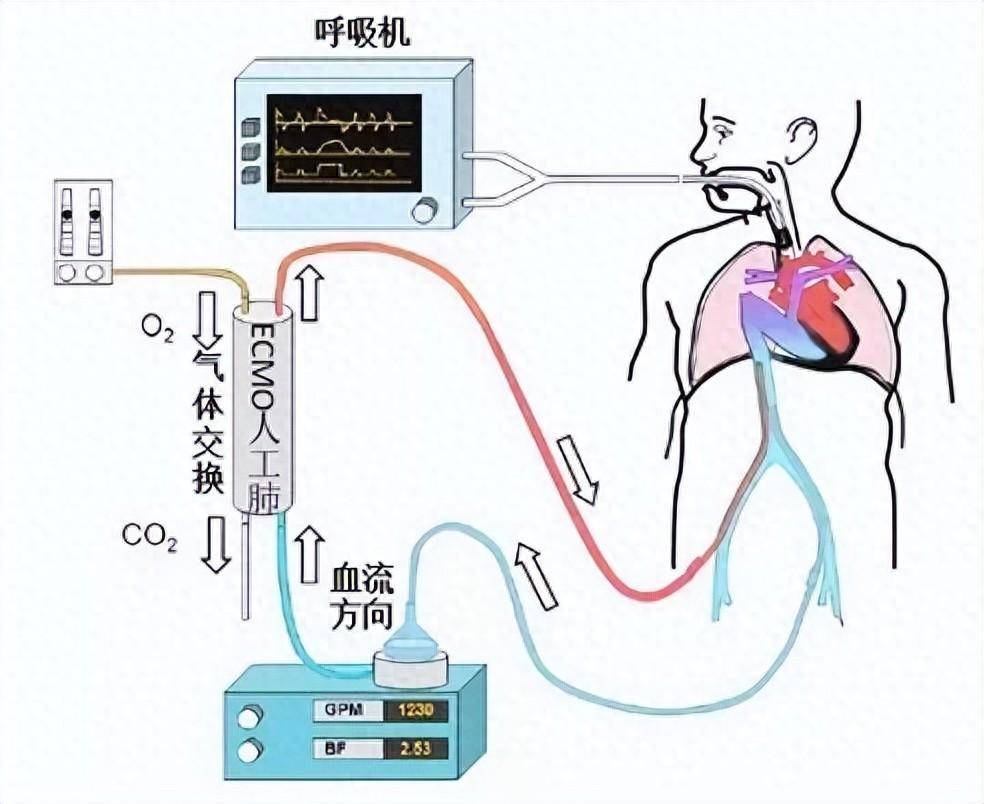 而到了2023年,根据众成大数据科技的统计,呼吸机国产化率已经达到75%