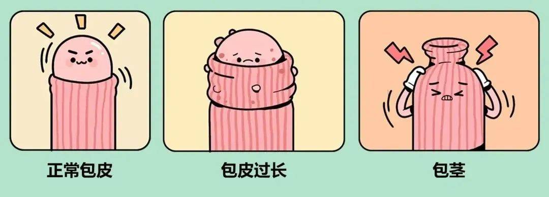 简单地说,能翻出来的,就是包皮过长;翻不出来的,就是包茎.