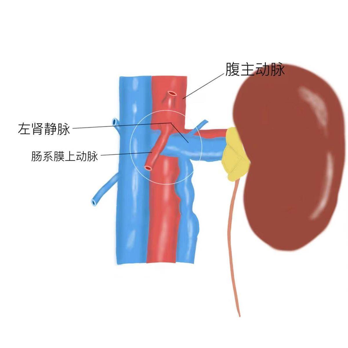 女子连续5年血尿,竟是腹中藏个"胡桃夹"