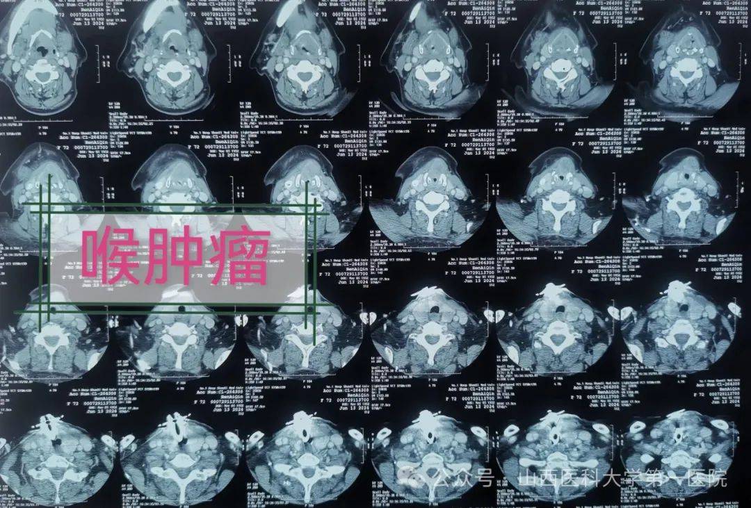 七旬老人喉癌术后复发合并颈部淋巴结转移 全喉切除颈部廓清根治手术