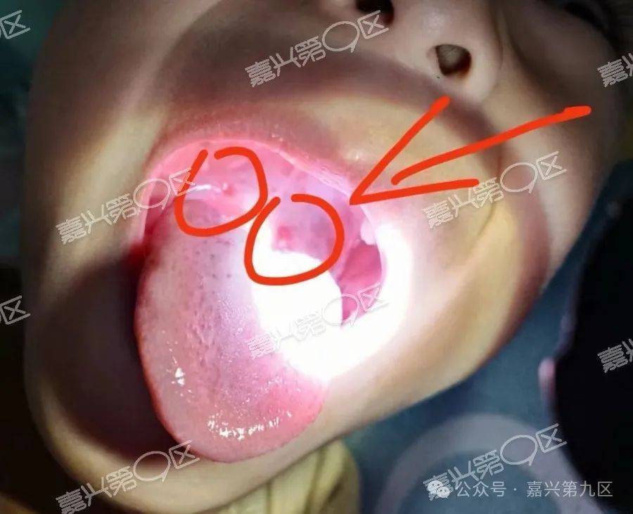 泻， 喉咙长满了“溃疡”！ 去医院里面一看， 被确诊为 疱疹性咽峡炎。