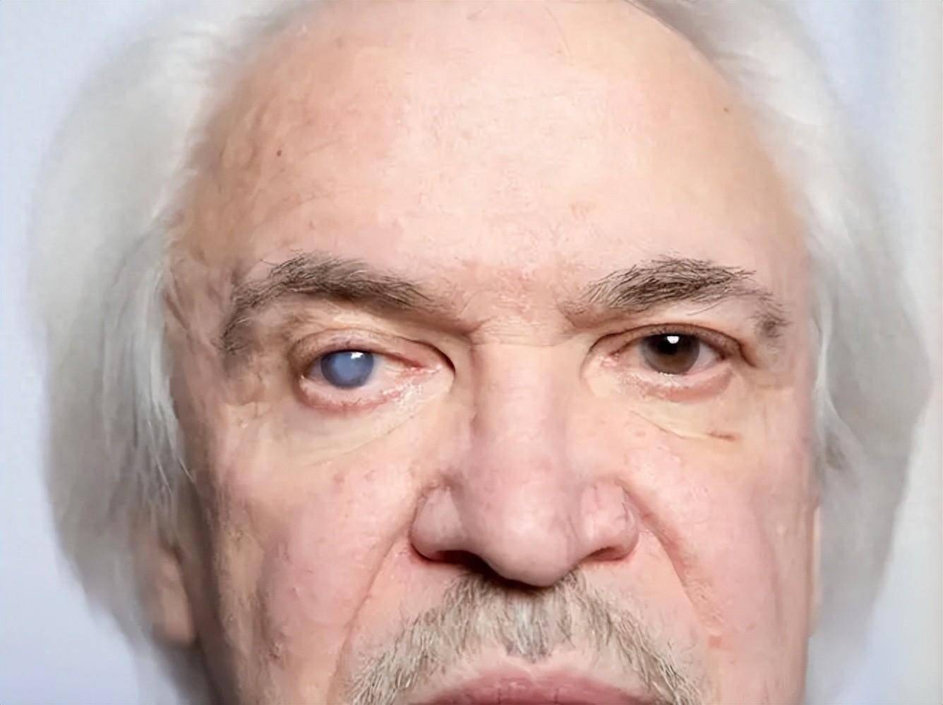 医生提醒:眼睛若有这几种异常,那白内障离你很近了,立即就医!