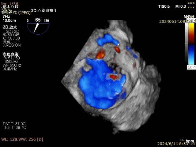 手术结果团队仔细斟酌患者病情,多方考虑,拟实施急诊二尖瓣teer手术.