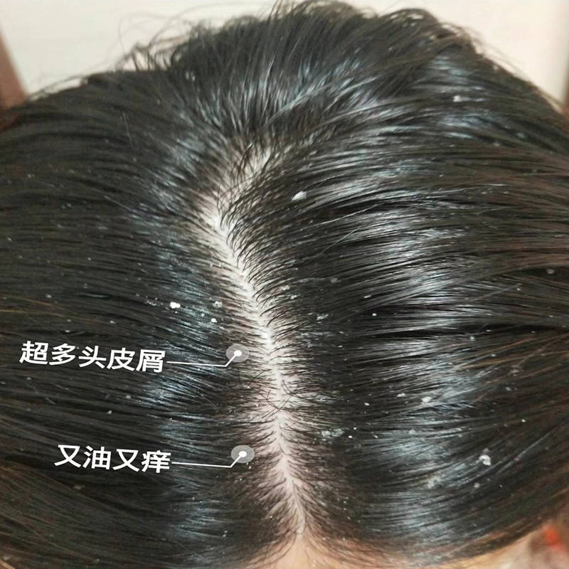头皮屑红疹等问题产生的原因:头皮屑,头痒和毛囊炎的产生可以归因于多
