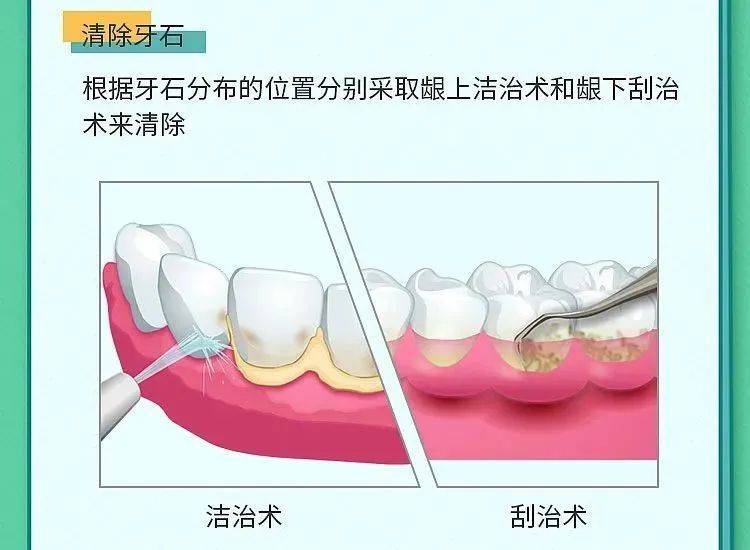 牙周炎:一个由牙菌斑引起的牙病!