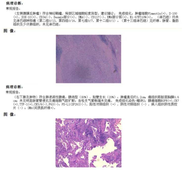 病理报告单 肿瘤图片