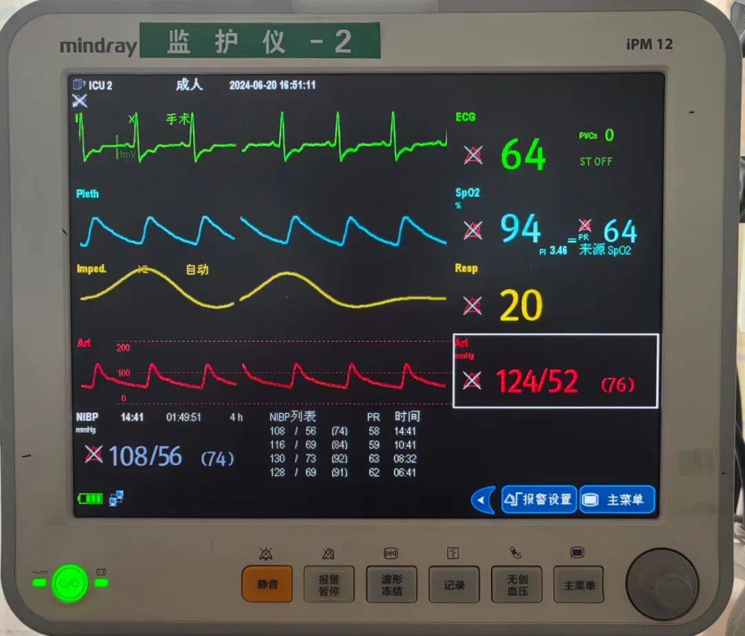 "旁做文章——超声引导下的远端桡动脉穿刺置管技术_部位_患者_血管