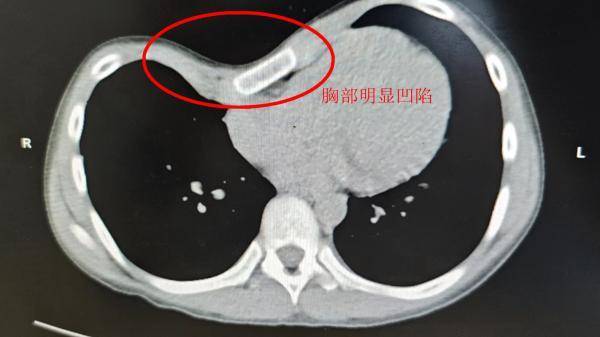 胸口中间凹陷图片