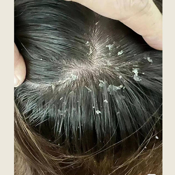 去头皮屑止痒洗发水?去头屑的洗发水推荐